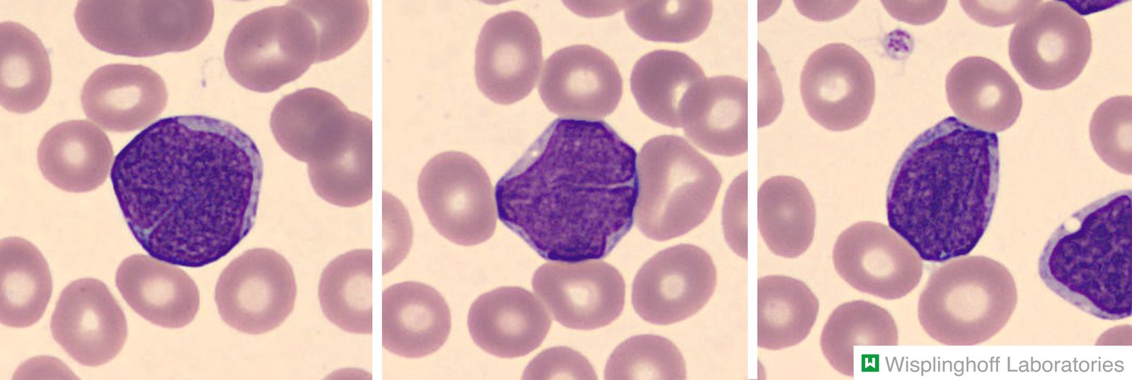 Mantle cell lymphoma