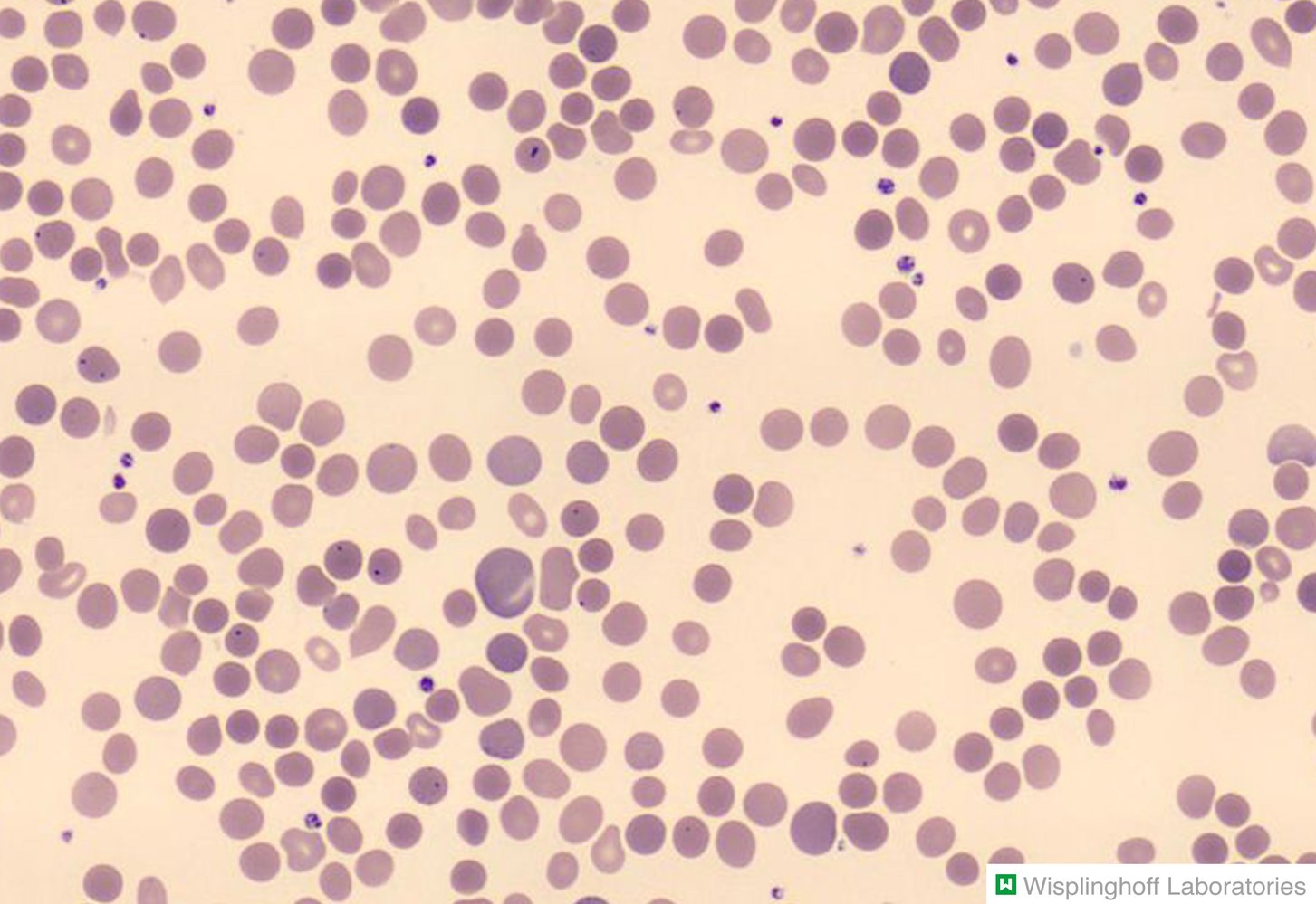 Spherocytosis