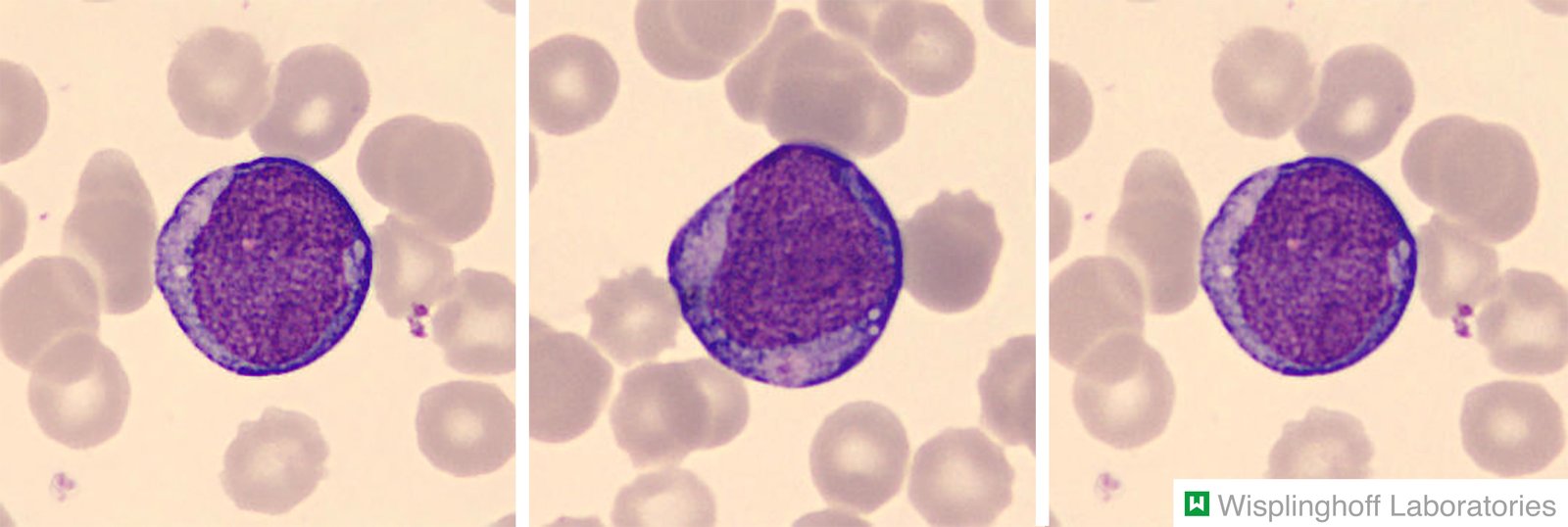 Acute monocytic leukemia
