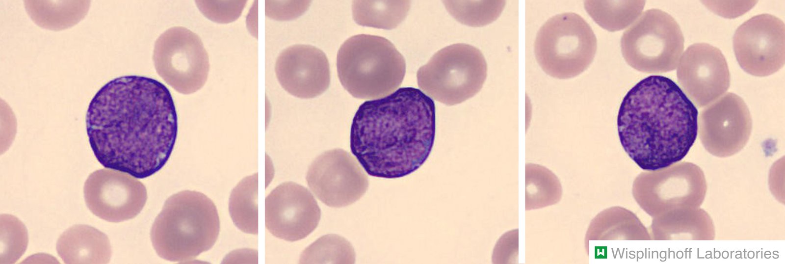 B-cell acute lymphoblastic leukemia