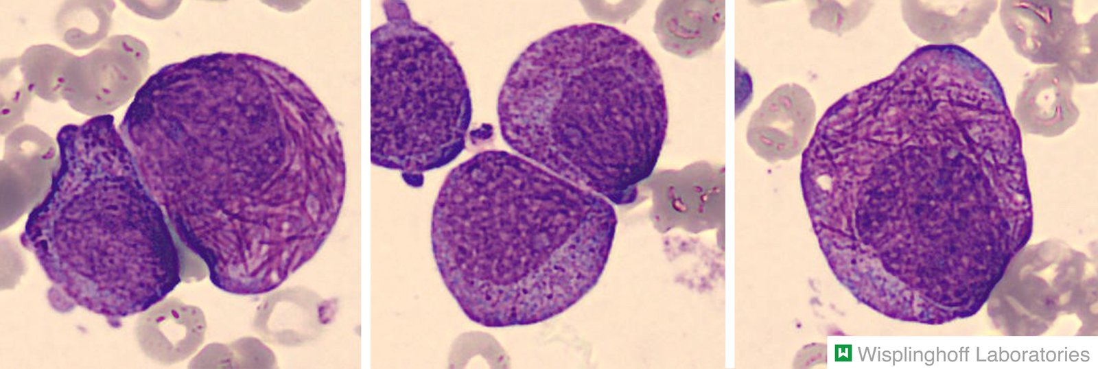 Acute promyelocytic leukemia