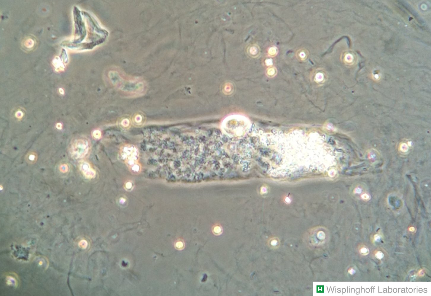 Granular cast in urine sediment