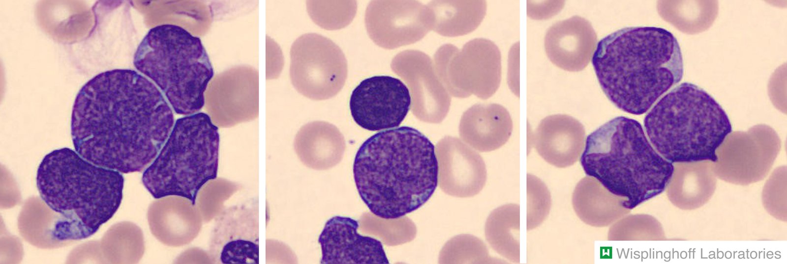 T-cell acute lymphoblastic leukemia