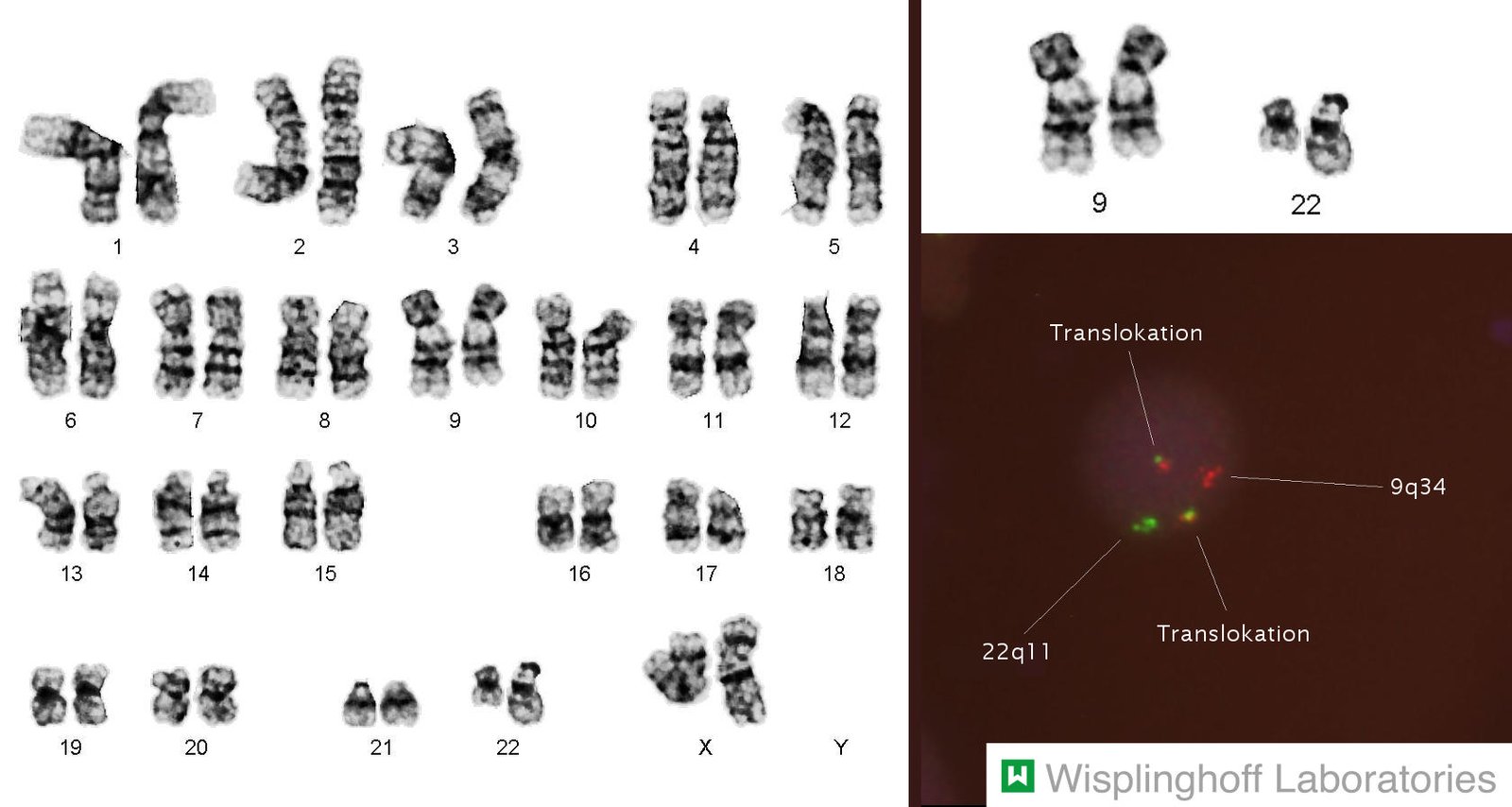 Chronic myeloid leukemia: t(9;22)(q34;q11) Philadelphia chromosome