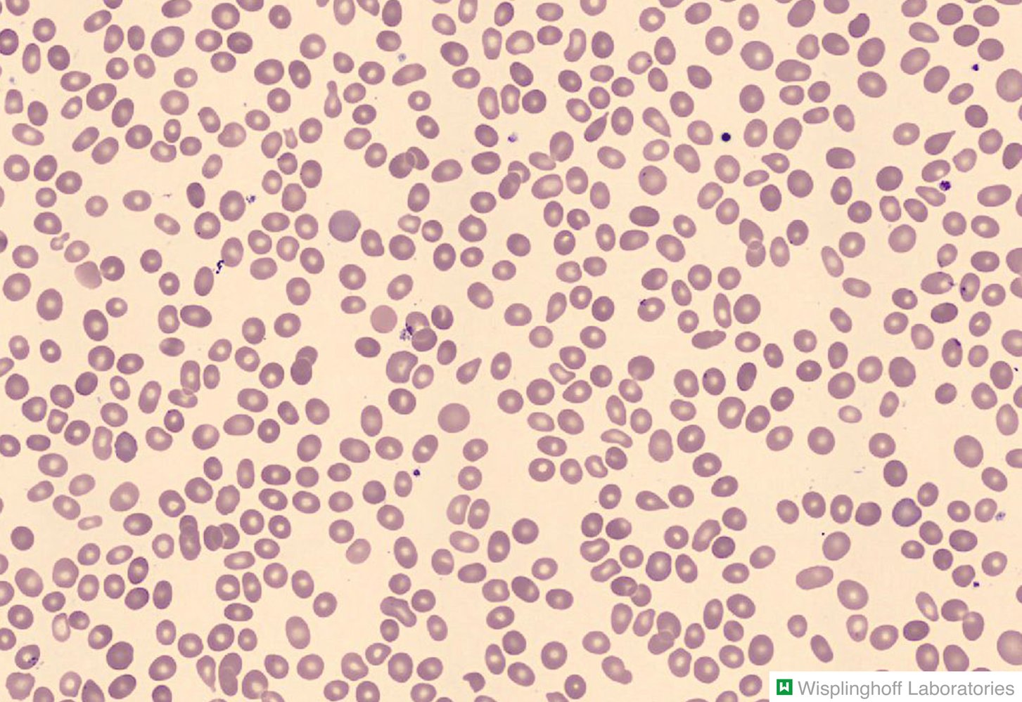 Dacrocytes