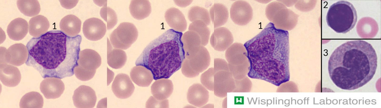 Atypical lymphocytosis in infectious mononucleosis