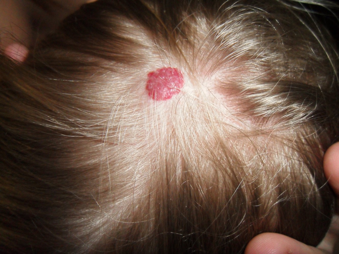 Infantile superficial hemangioma