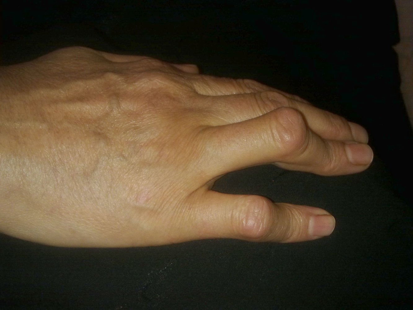 Boutonniere deformity