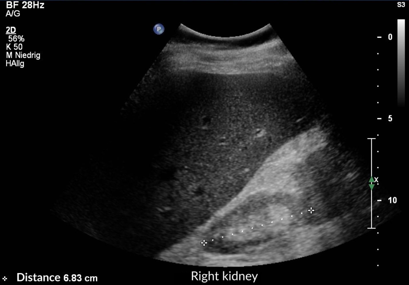 Atrophic kidney