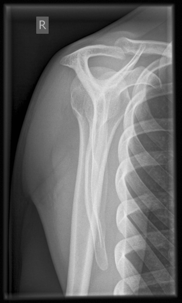 Y view (lateral scapula view) of the shoulder