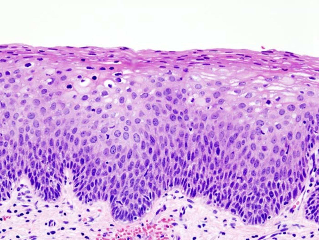 Cervical intraepithelial neoplasia (CIN II)