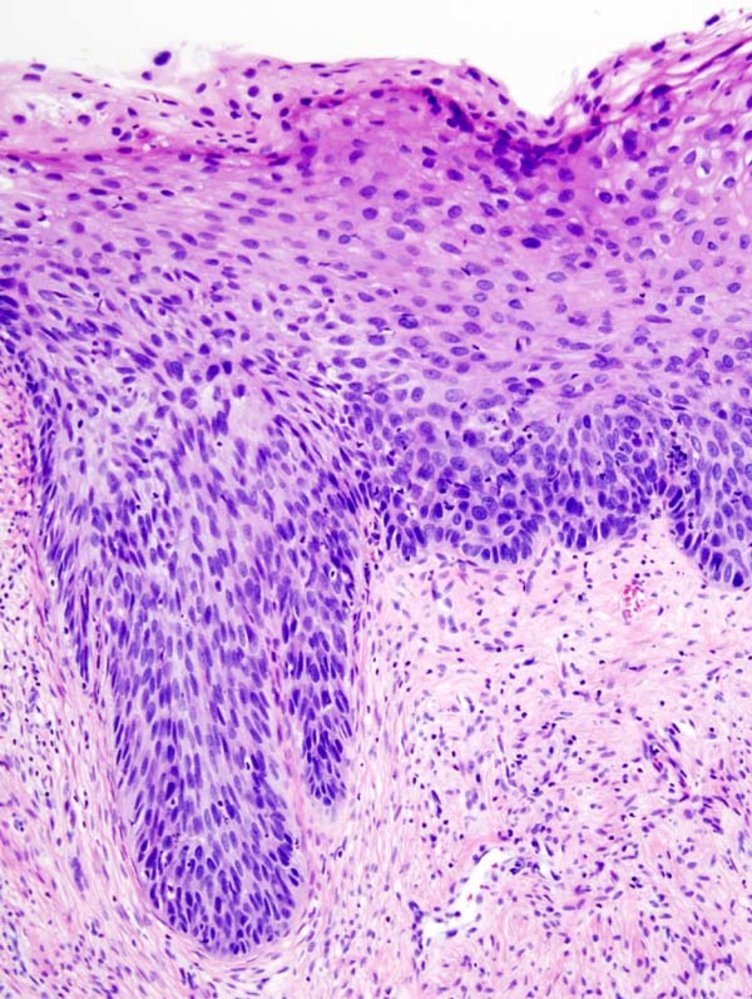 Cervical intraepithelial neoplasia (CIN III)