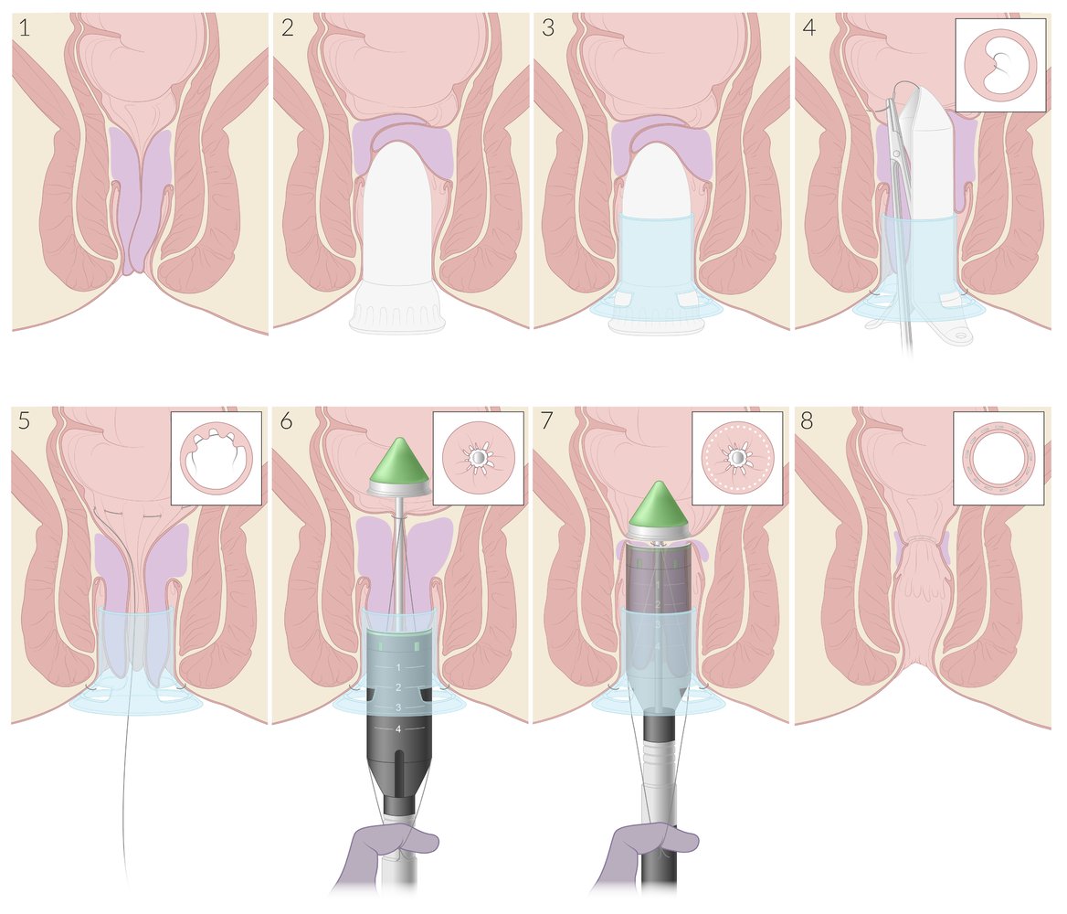 Stapled hemorrhoidopexy (Longo procedure): steps