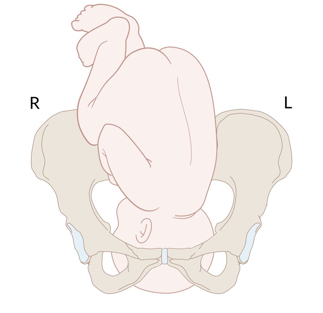 Left occiput anterior position