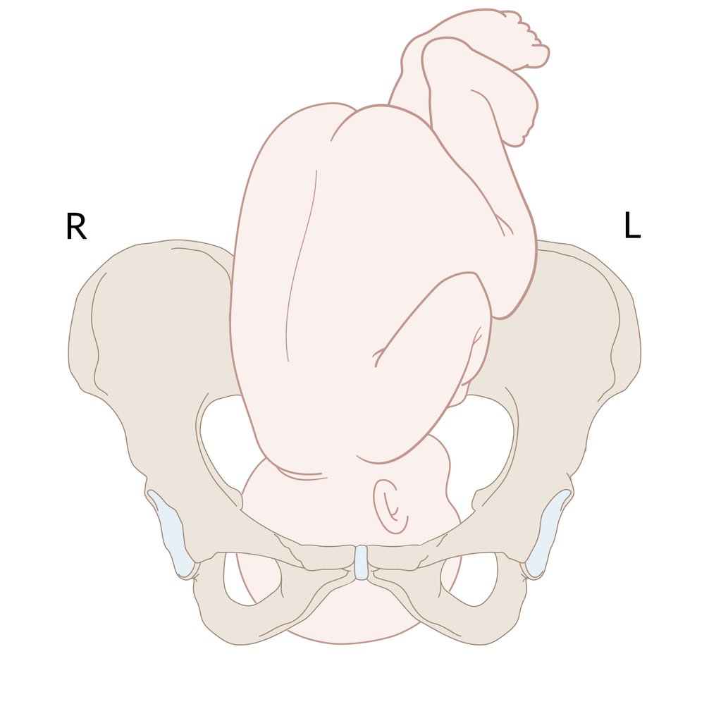 Right occiput anterior position
