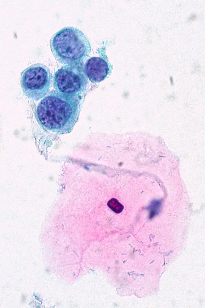 Pap smear showing severe dysplasia