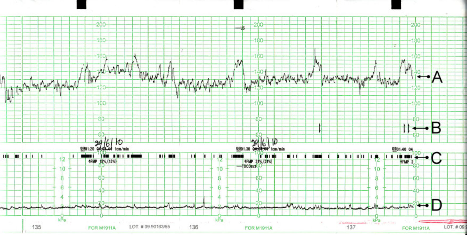 CTG with normal findings