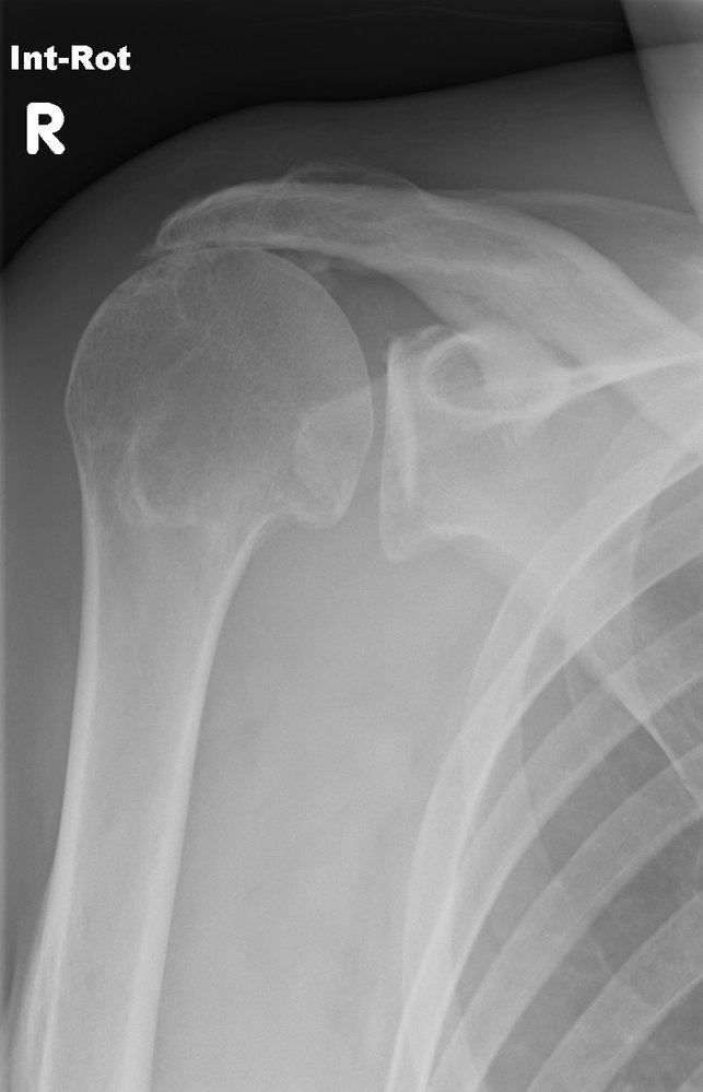 Rotator cuff tear