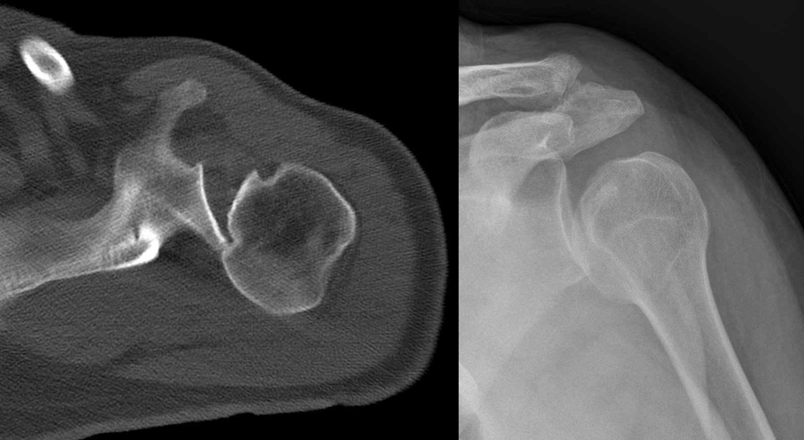 Inverse Hill Sachs lesion following a posterior shoulder dislocation in CT and X-ray
