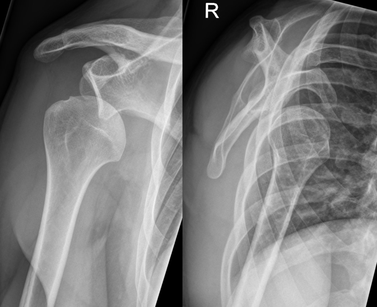 Anterior shoulder dislocation with Hill-Sachs lesion