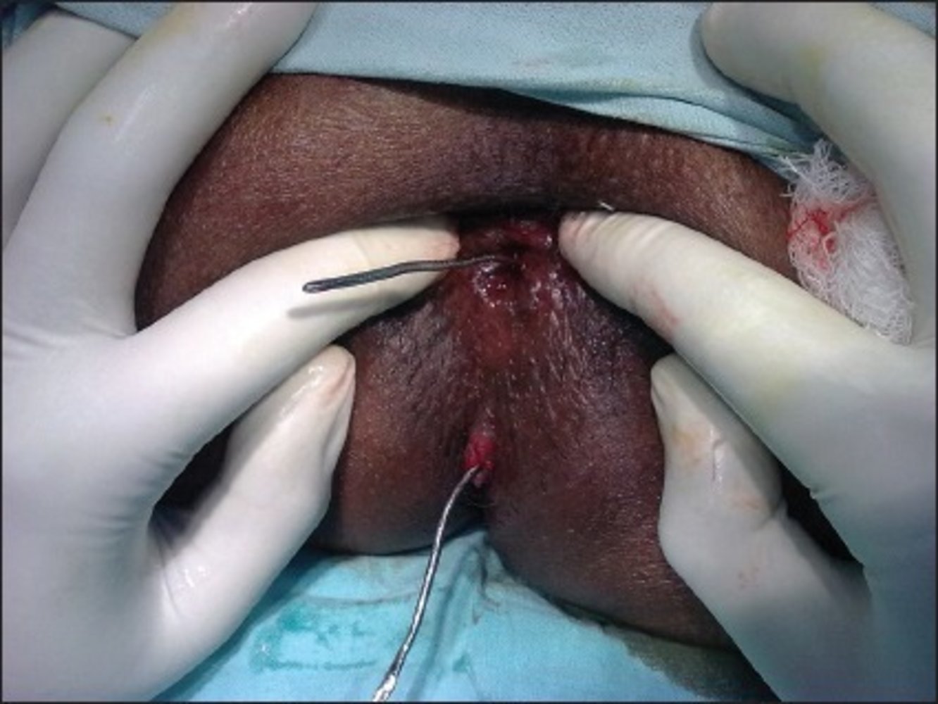 Anal fistula