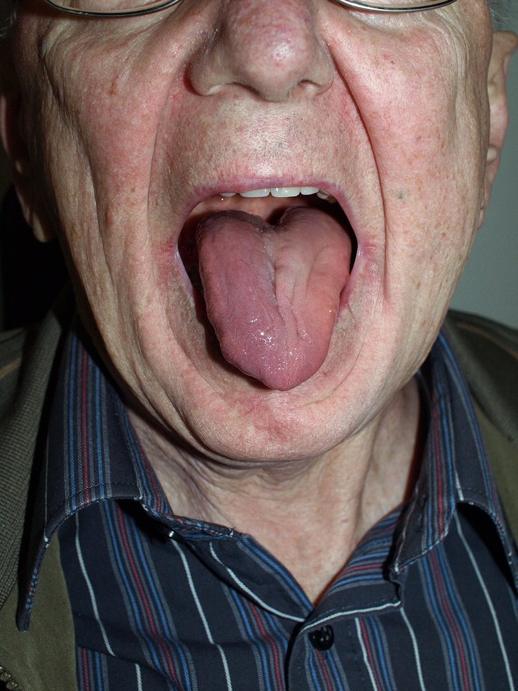 Hypoglossal nerve lesion
