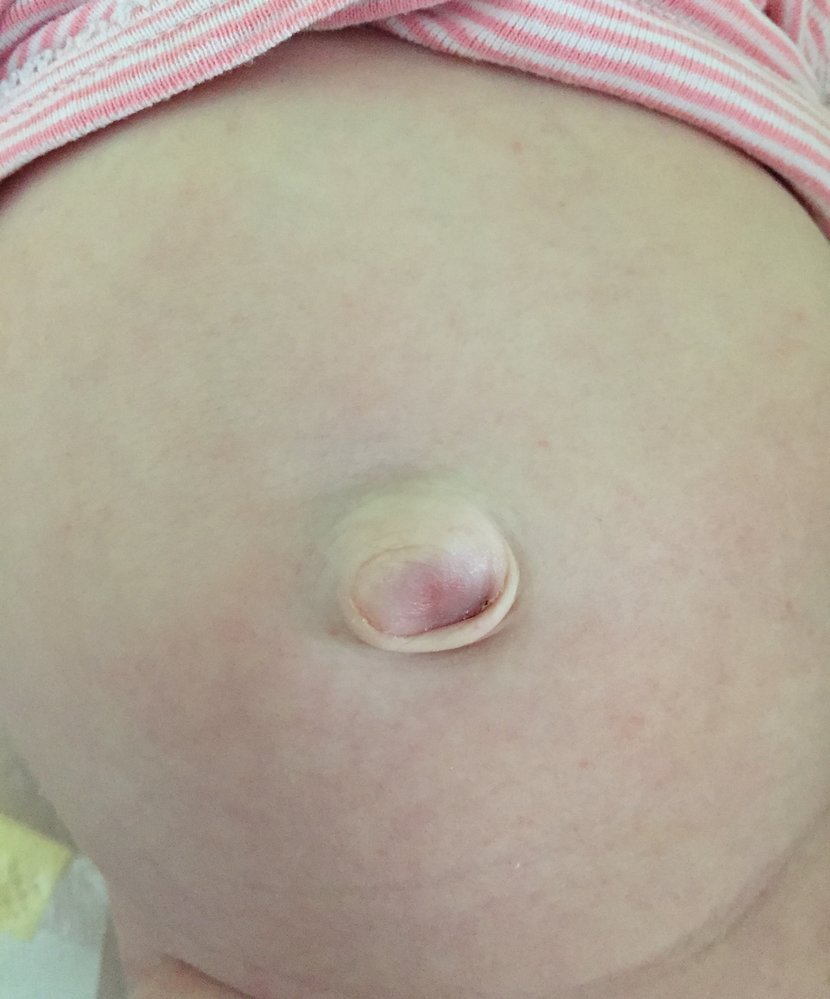 Congenital umbilical hernia