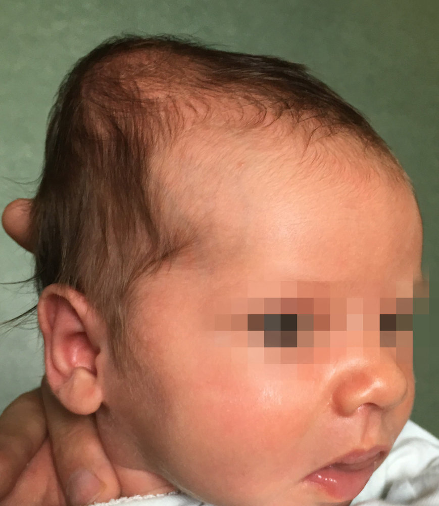 Cephalohematoma (1/2)