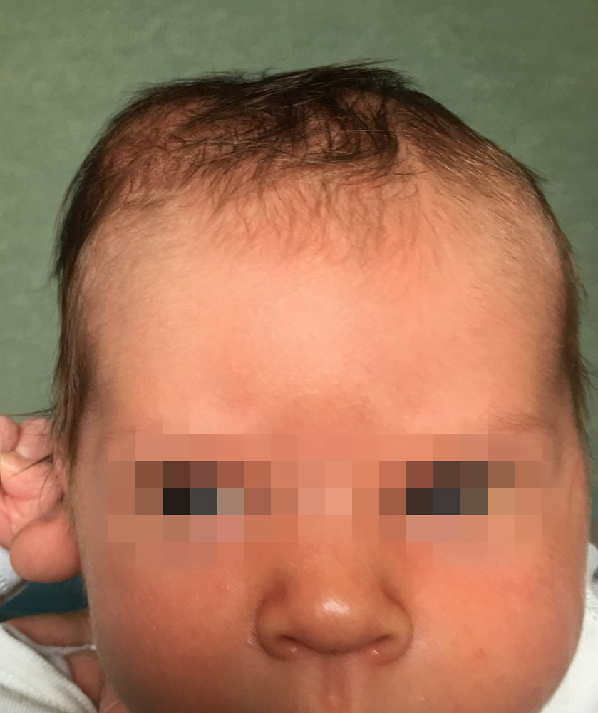 Cephalohematoma (2/2)