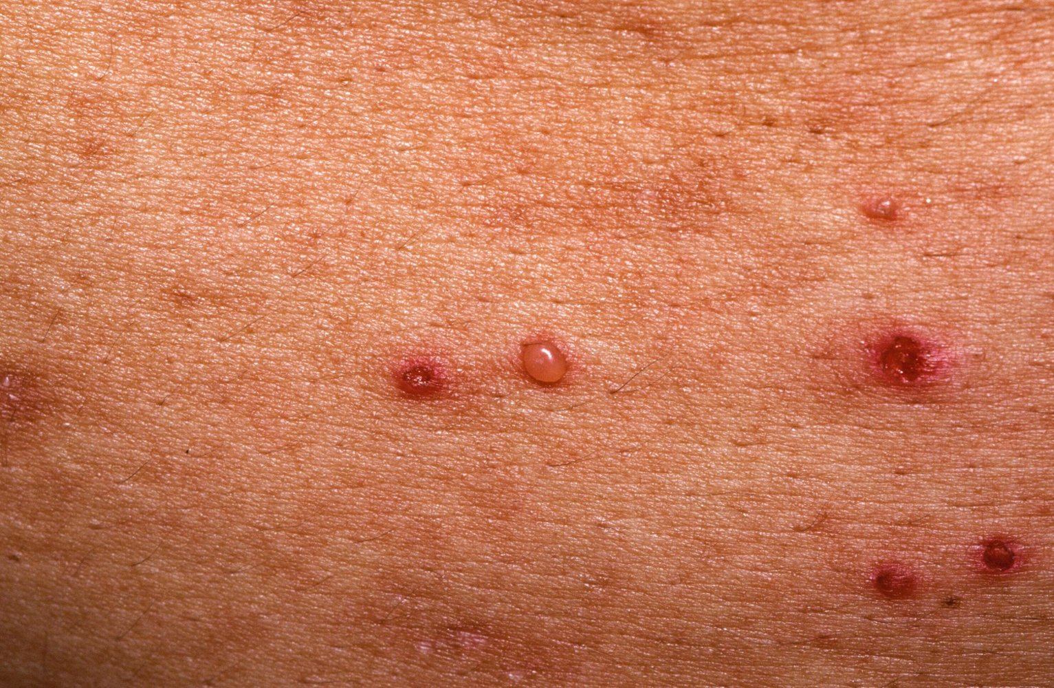 Pemphigus vulgaris