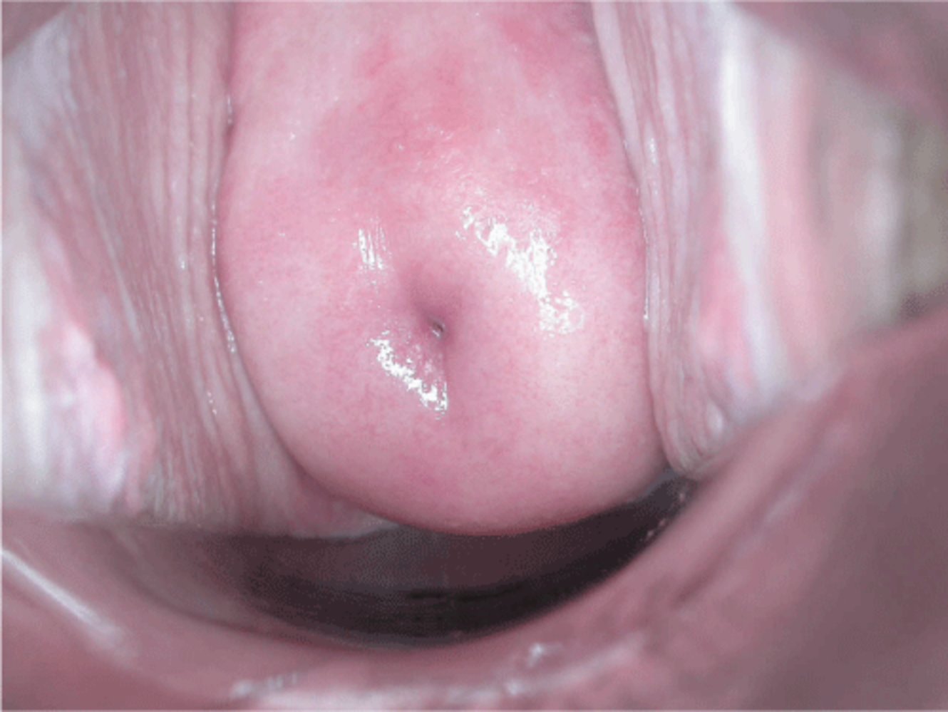 Ectocervix