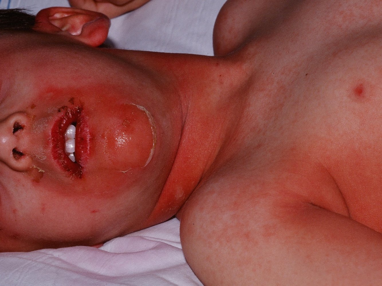 Staphylococcal scalded skin syndrome
