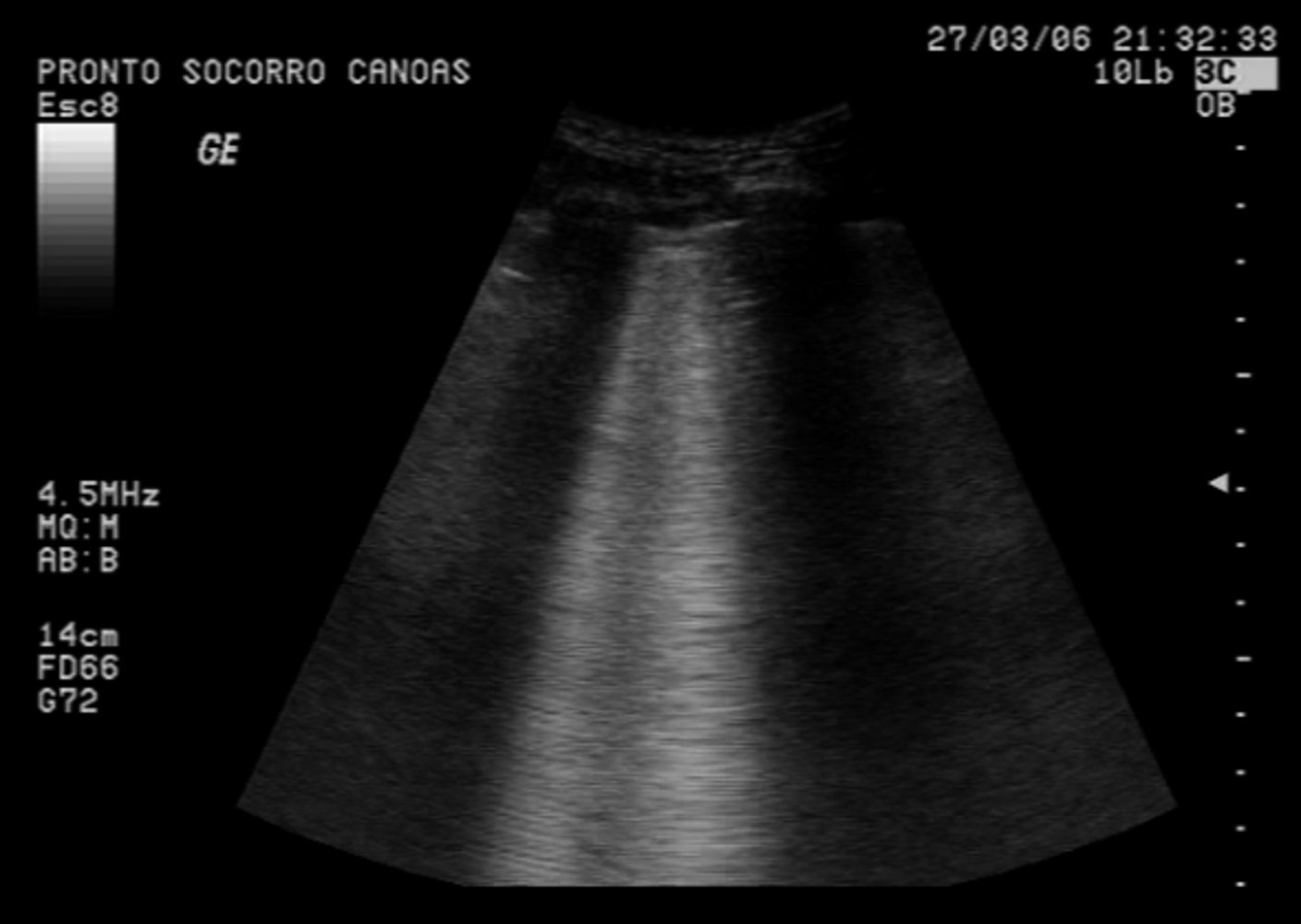B-lines on lung ultrasound