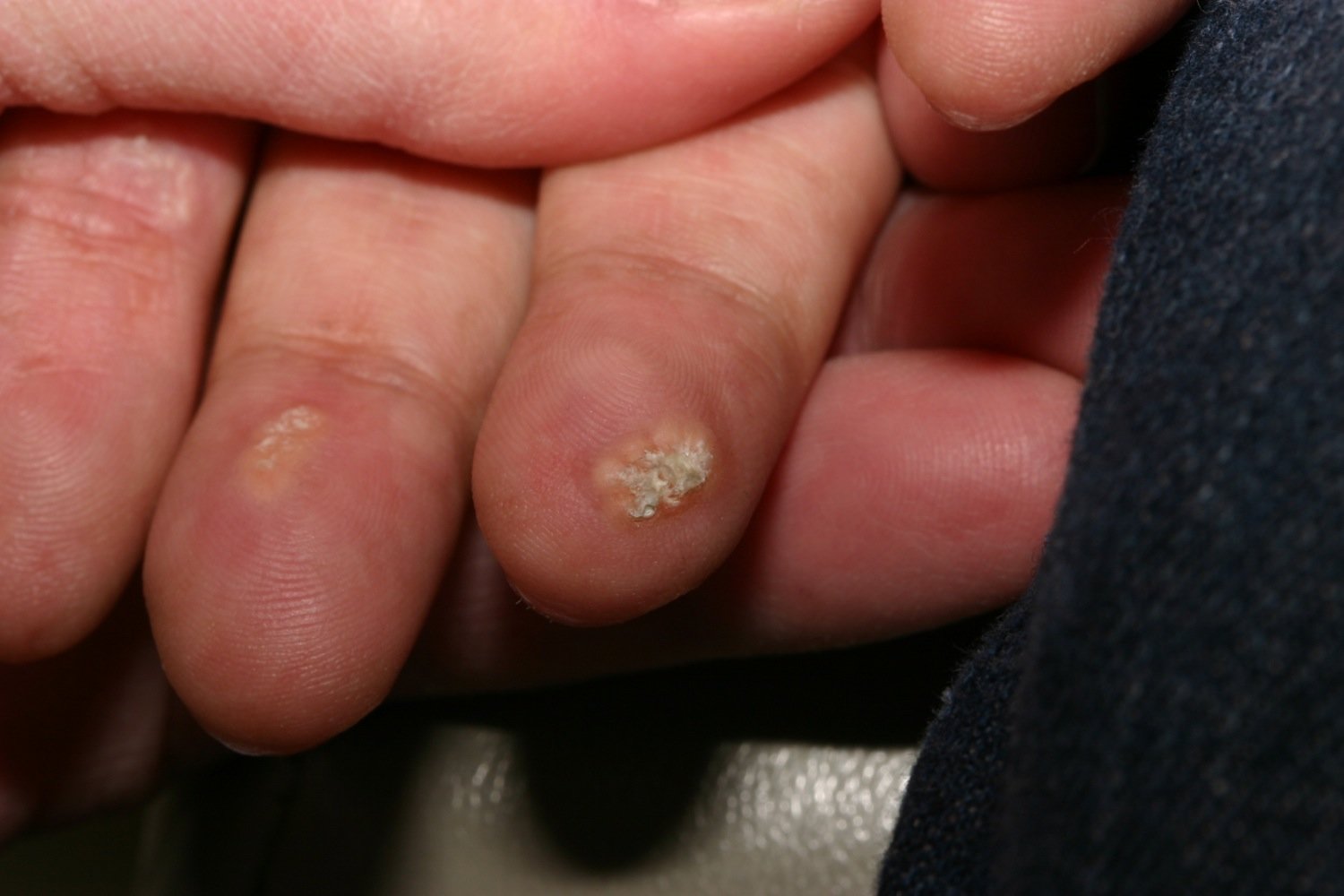 Calcinosis cutis