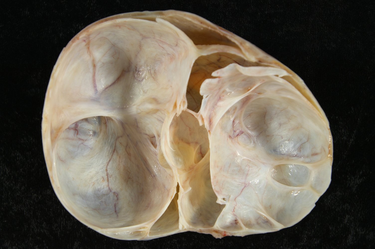 Ovarian mucinous cystadenoma