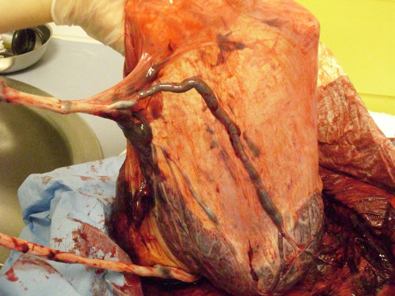Velamentous cord insertion