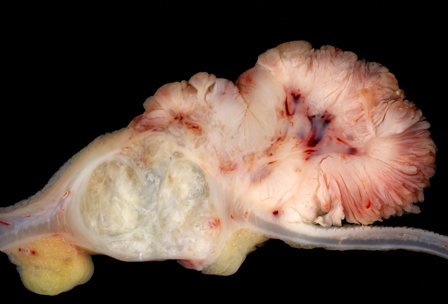 Villous adenoma and adenocarcinoma of the colon