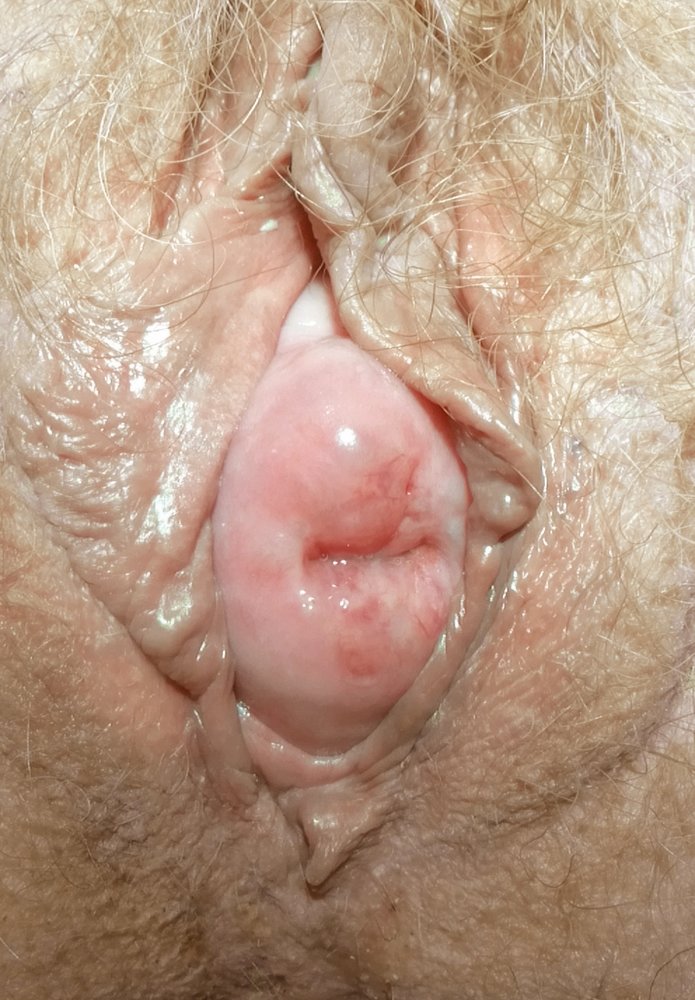 Stage 3 pelvic organ prolapse