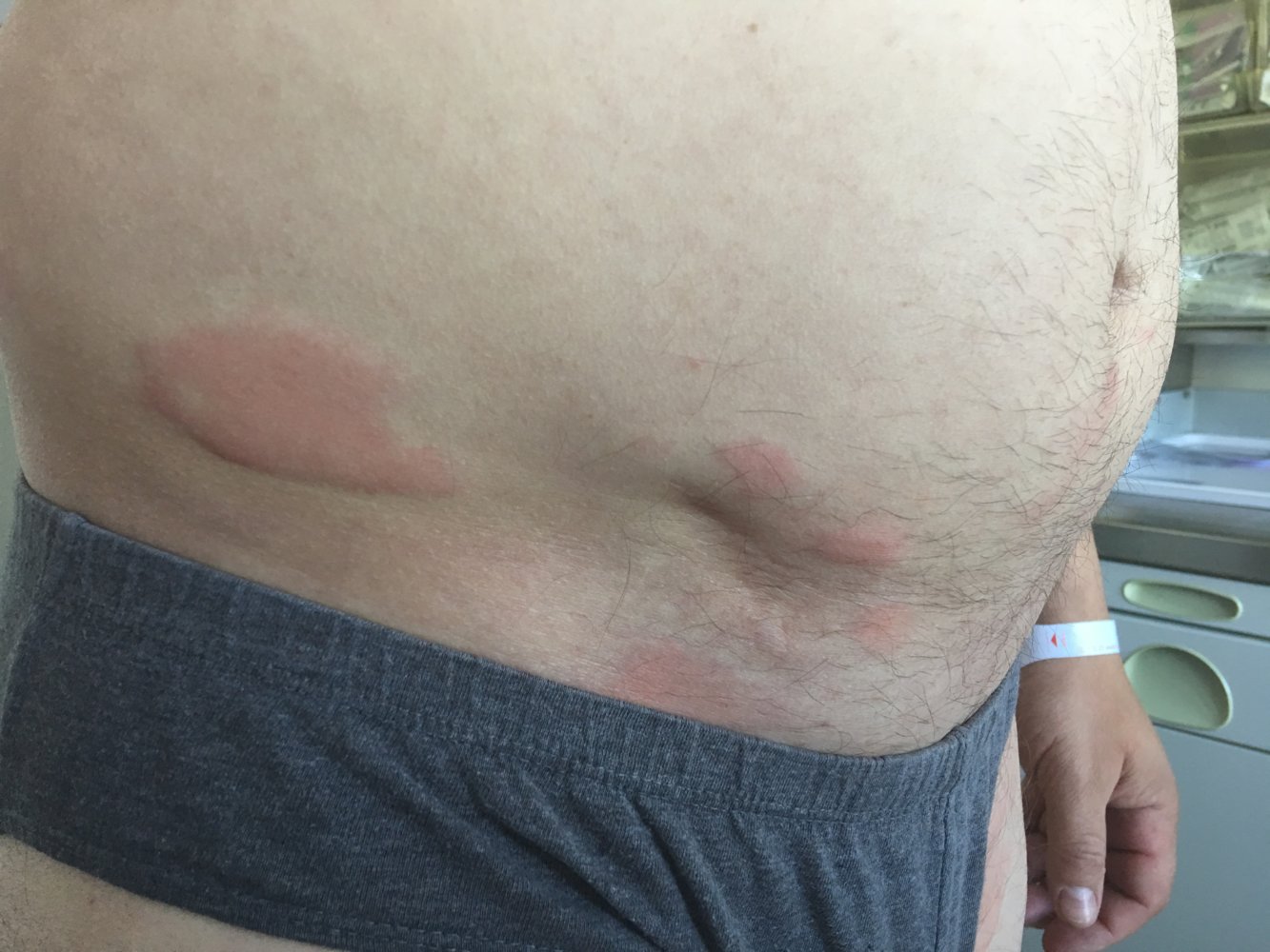 Urticaria (hives)