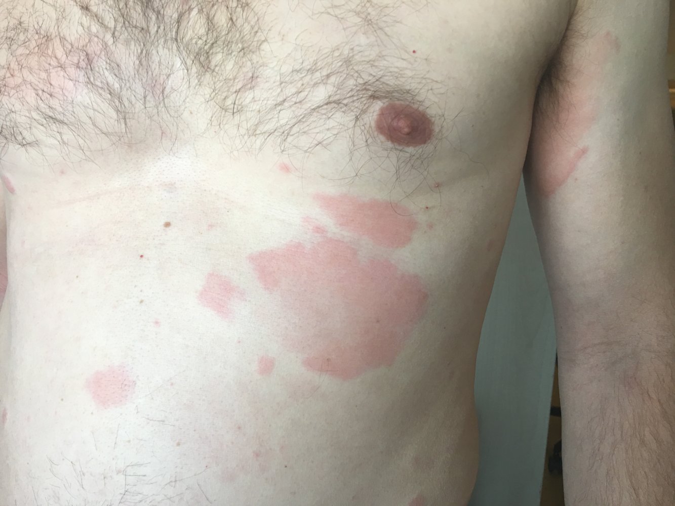 Urticaria