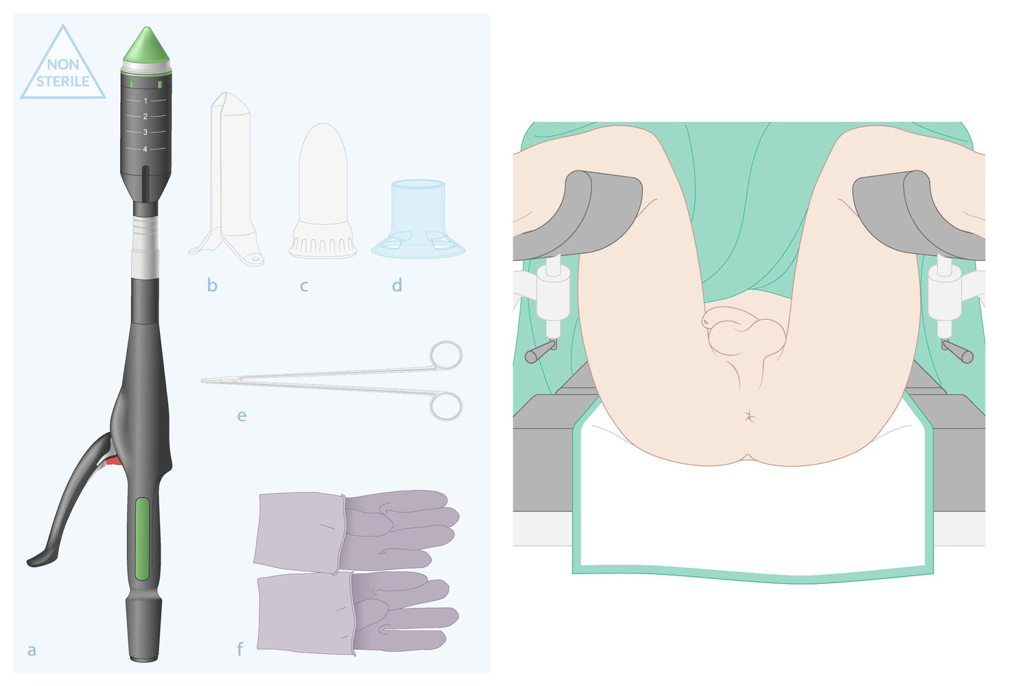 Stapled hemorrhoidopexy (Longo procedure): instruments and patient positioning