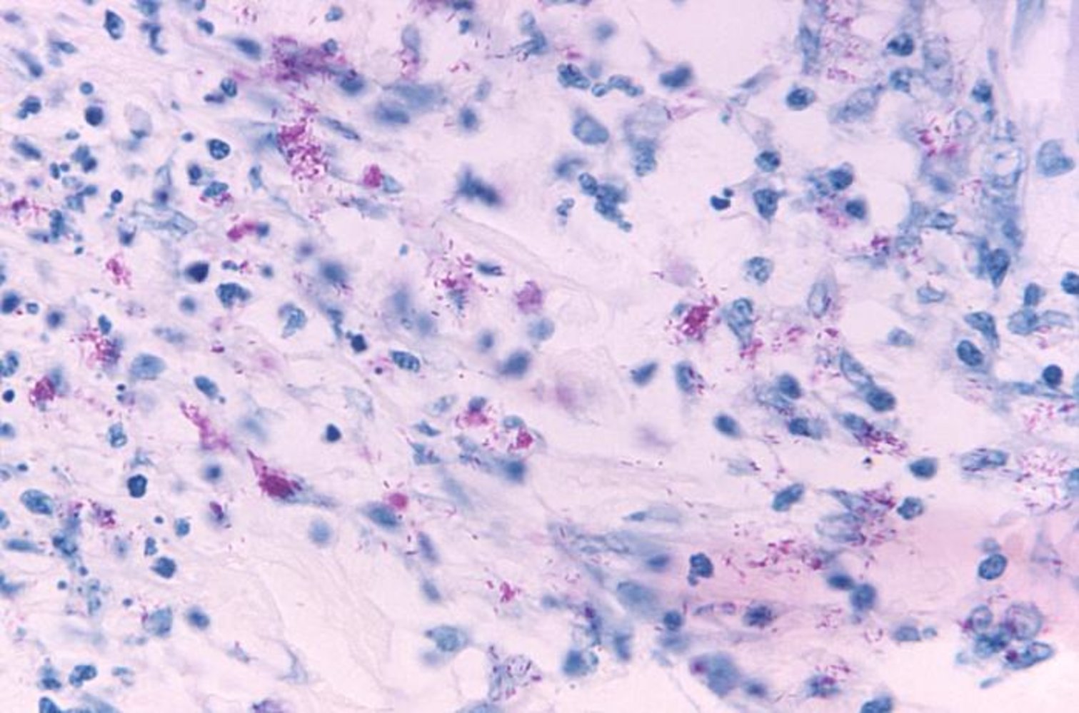 Mycobacteria