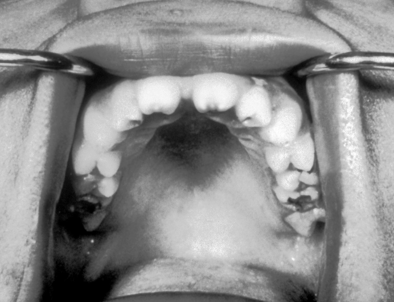 Hutchinson's Teeth resulting from congenital syphilis