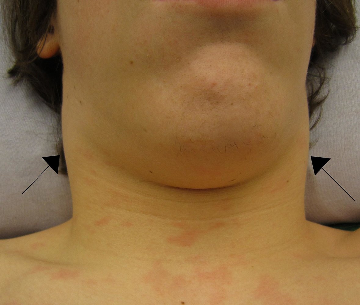 Lymphadenopathy in a patient with mononucleosis
