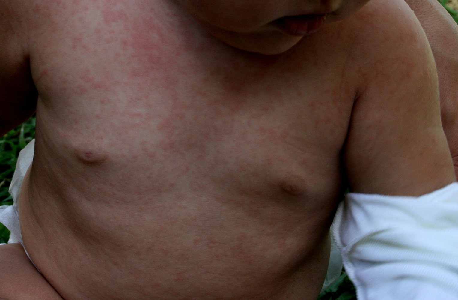 Roseola infantum (exanthem subitum)