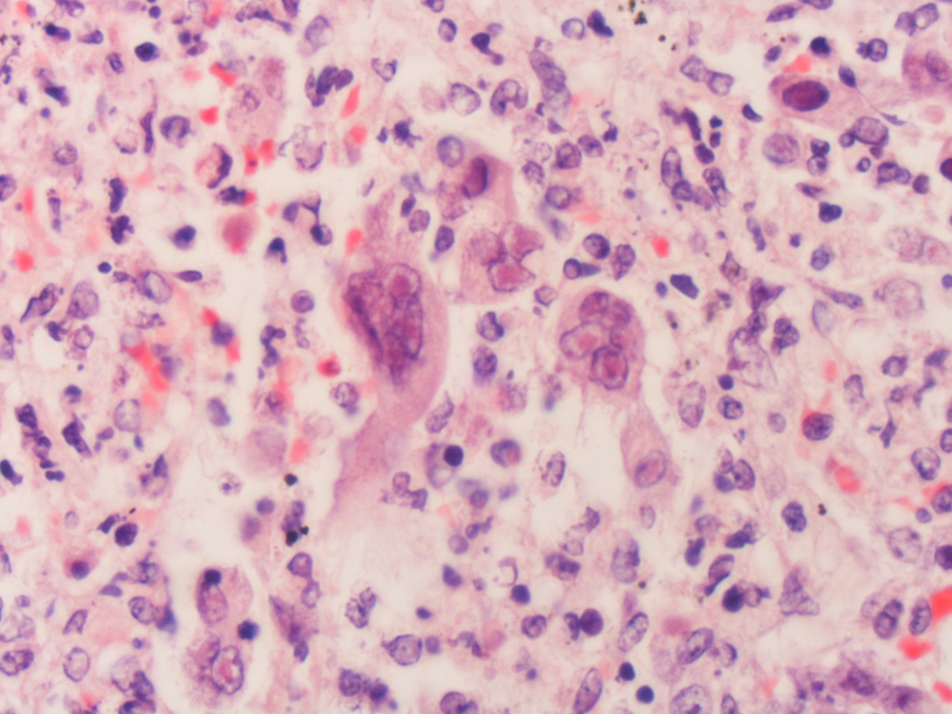 Multinucleated giant cells with Cowdry type A inclusions