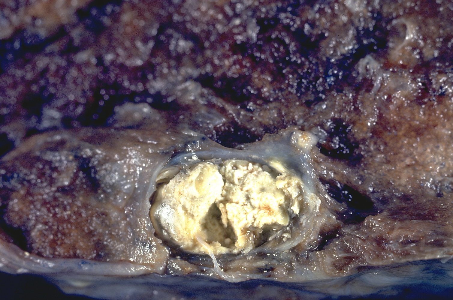 Caseous necrosis in lung tissue