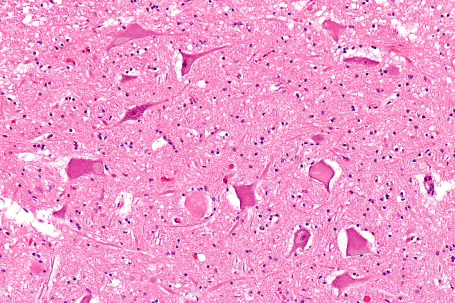 Chromatolysis