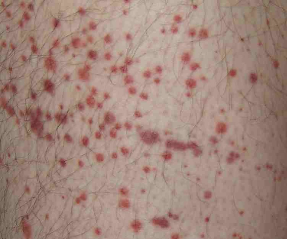 Purpura in IgA vasculitis