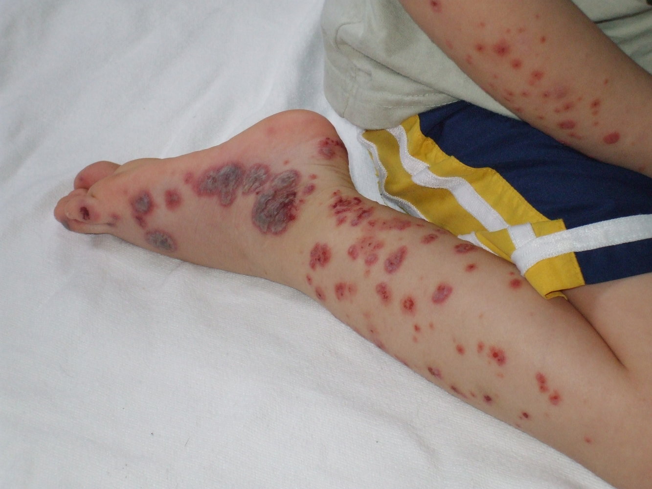 Purpura in IgA vasculitis